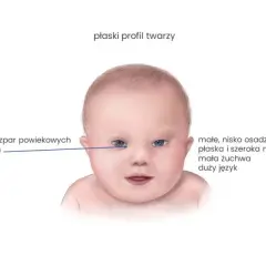 Kiedy wiadomo, że dziecko ma zespół Downa? Objawy i diagnoza
