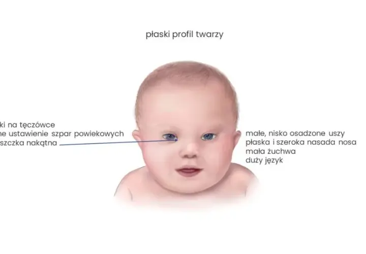 Kiedy wiadomo, że dziecko ma zespół Downa? Objawy i diagnoza