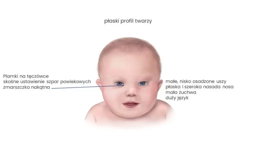 Kiedy wiadomo, że dziecko ma zespół Downa? Objawy i diagnoza