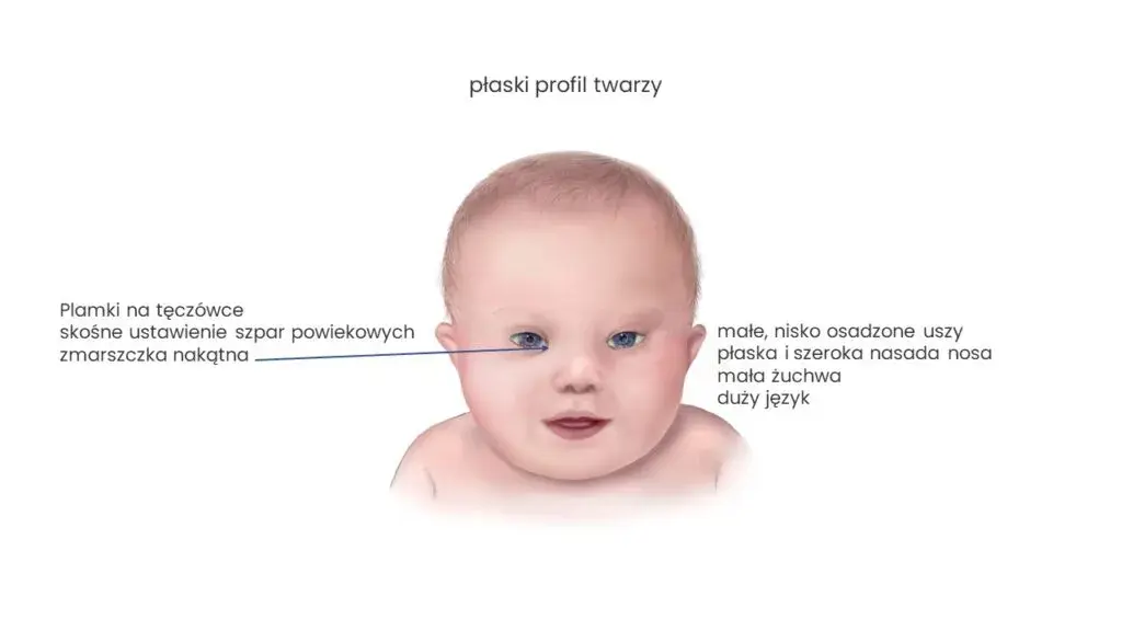 Kiedy wiadomo, że dziecko ma zespół Downa? Objawy i diagnoza