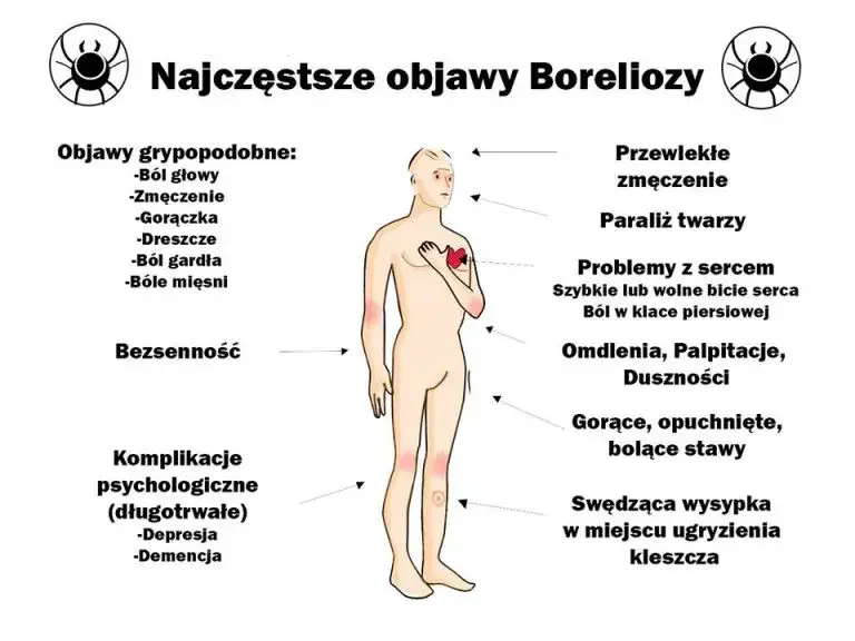 Zdjęcie Borelioza objawy psychiczne: jak neuroborelioza wpływa na psychikę?